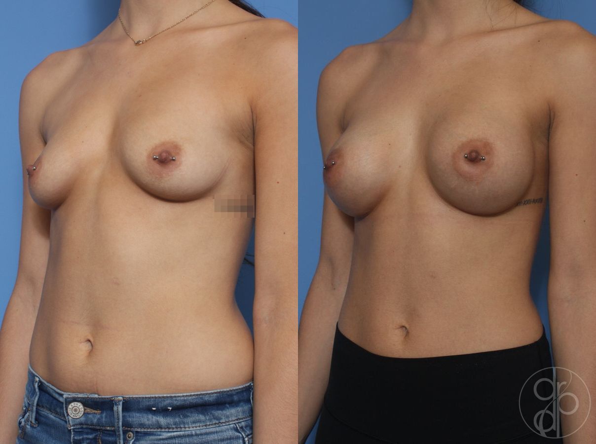 Before and after Breast Augmentation case 29944 - Angle 2