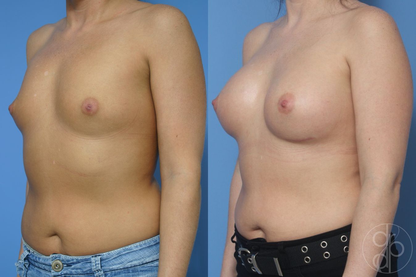 Before and after Breast Augmentation case 29915 - Angle 3