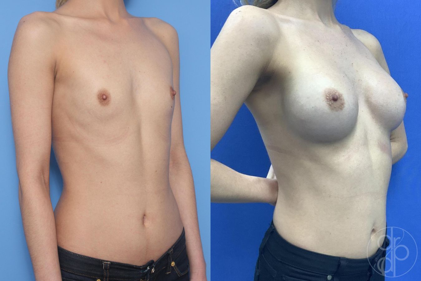 Before and after Breast Augmentation case 29935 - Angle 4