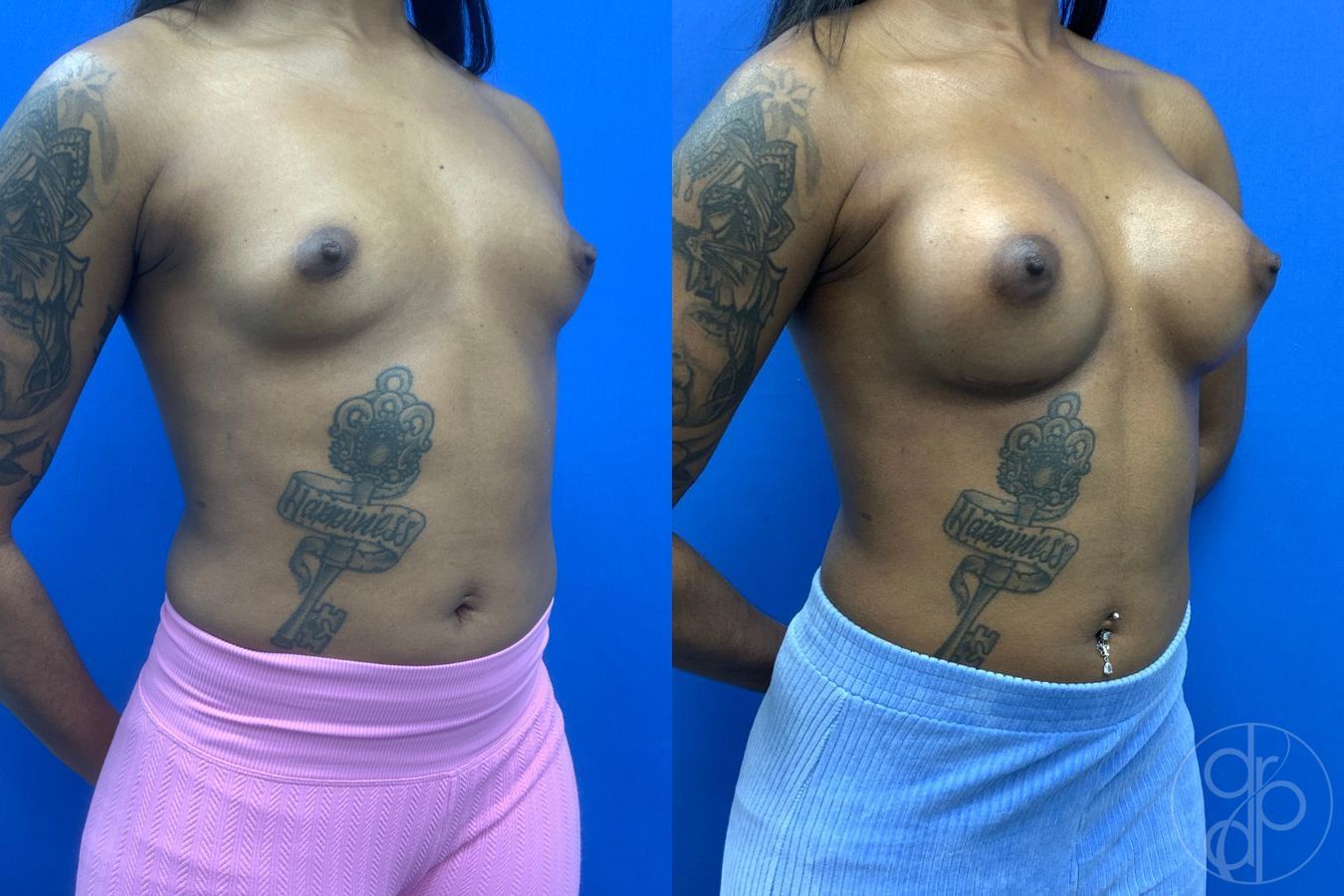 Before and after Breast Augmentation case 43488 - Angle 3