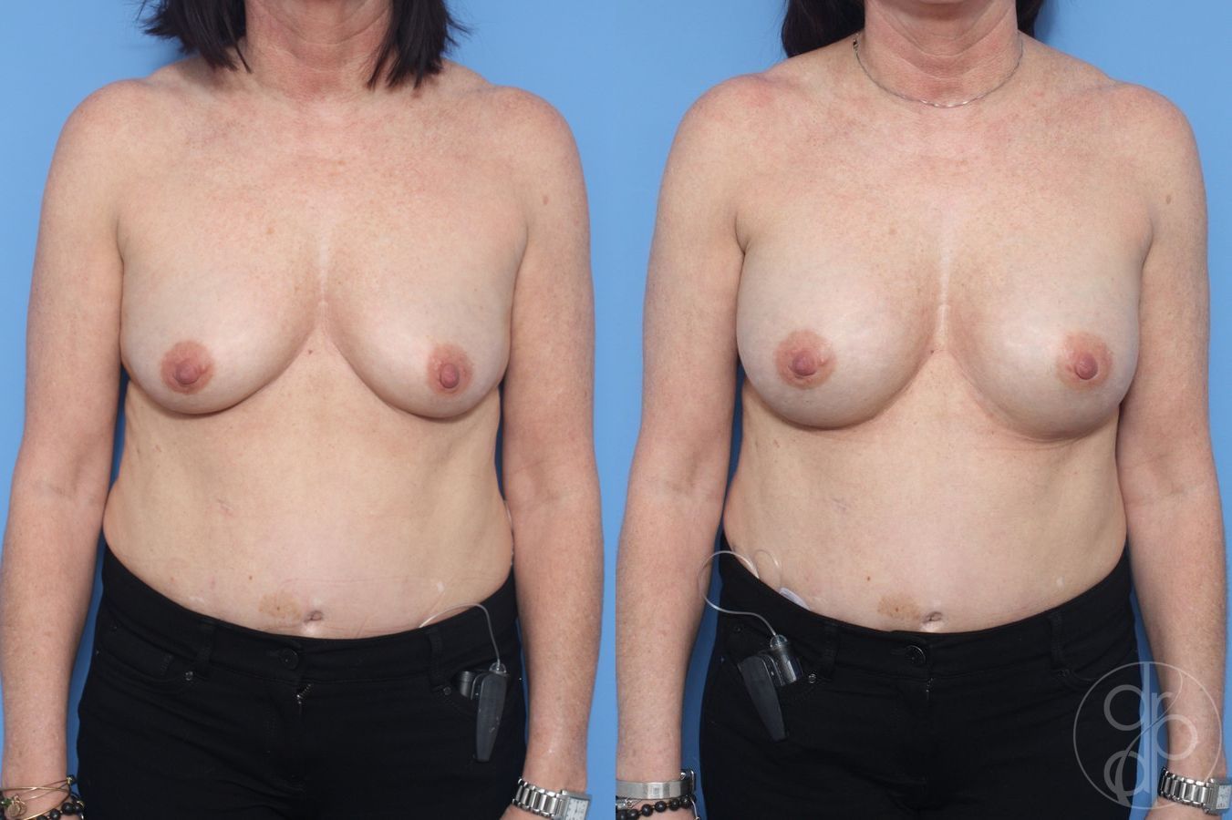 Before and after Breast Augmentation case 29905