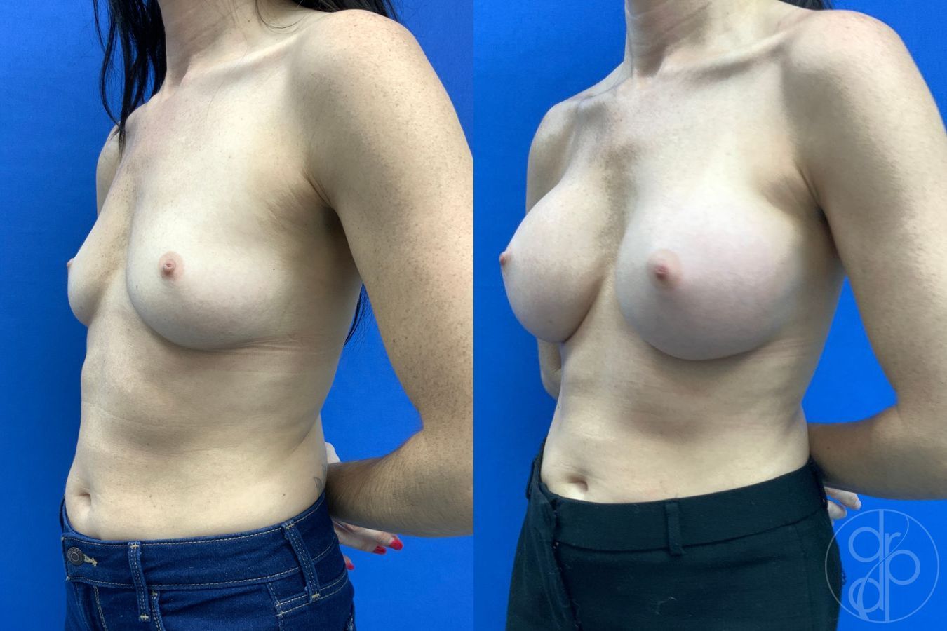 Before and after Breast Augmentation case 43194 - Angle 4