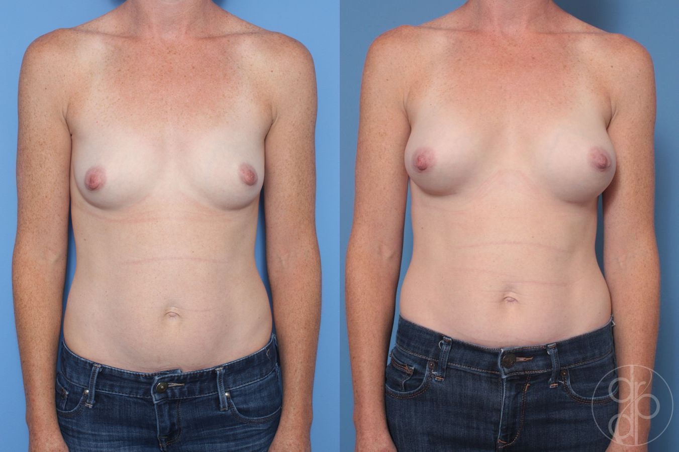 Before and after Breast Augmentation case 29936