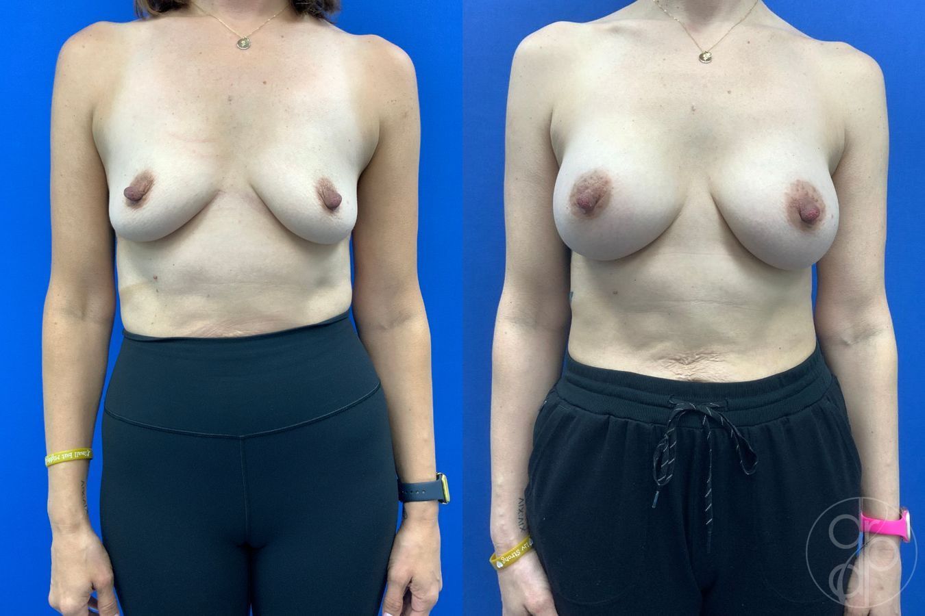 Before and after Breast Augmentation case 46262