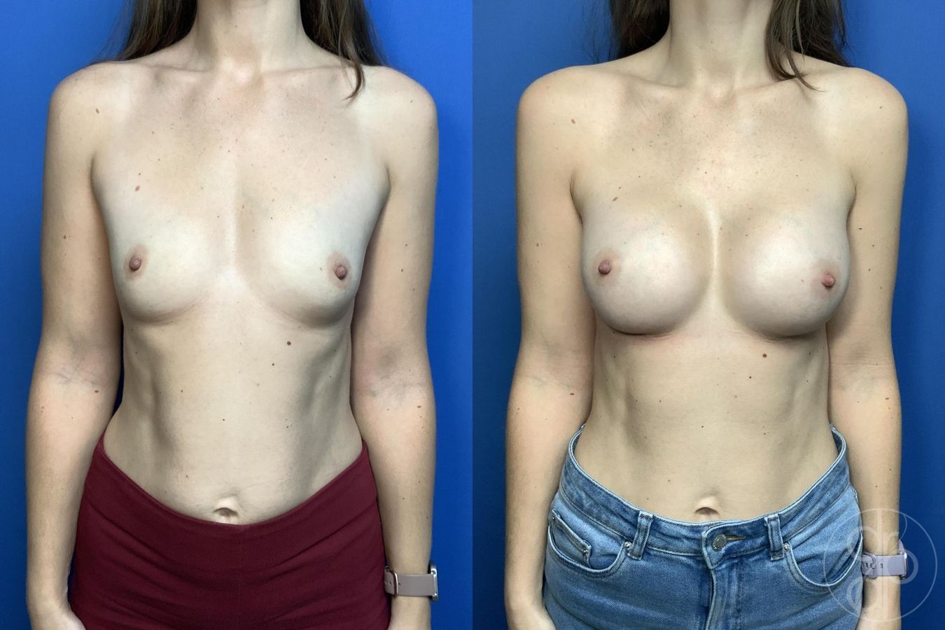 Before and after Breast Augmentation case 29991