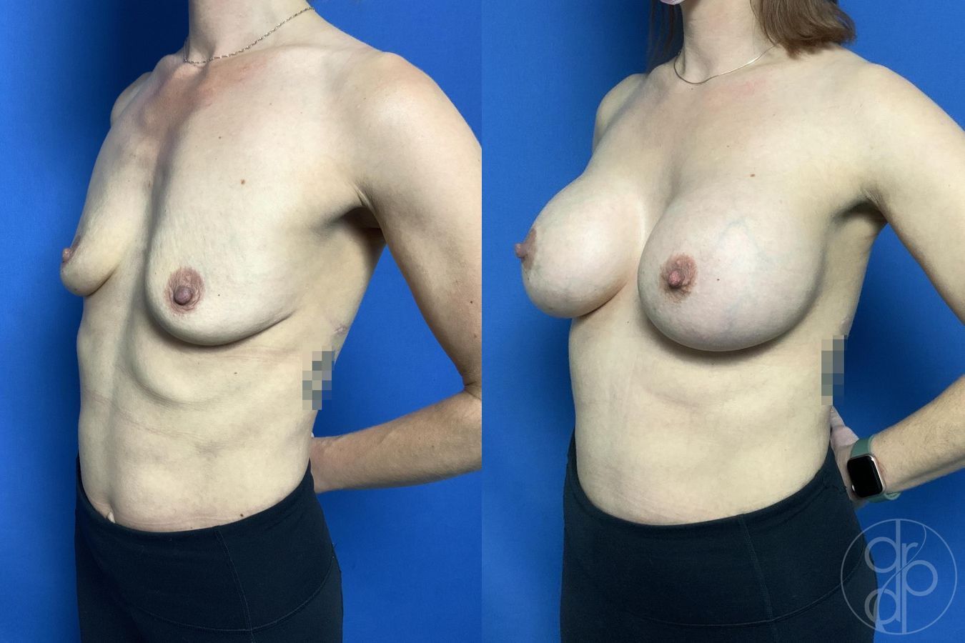 Breast Augmentation - Thumbnail 3