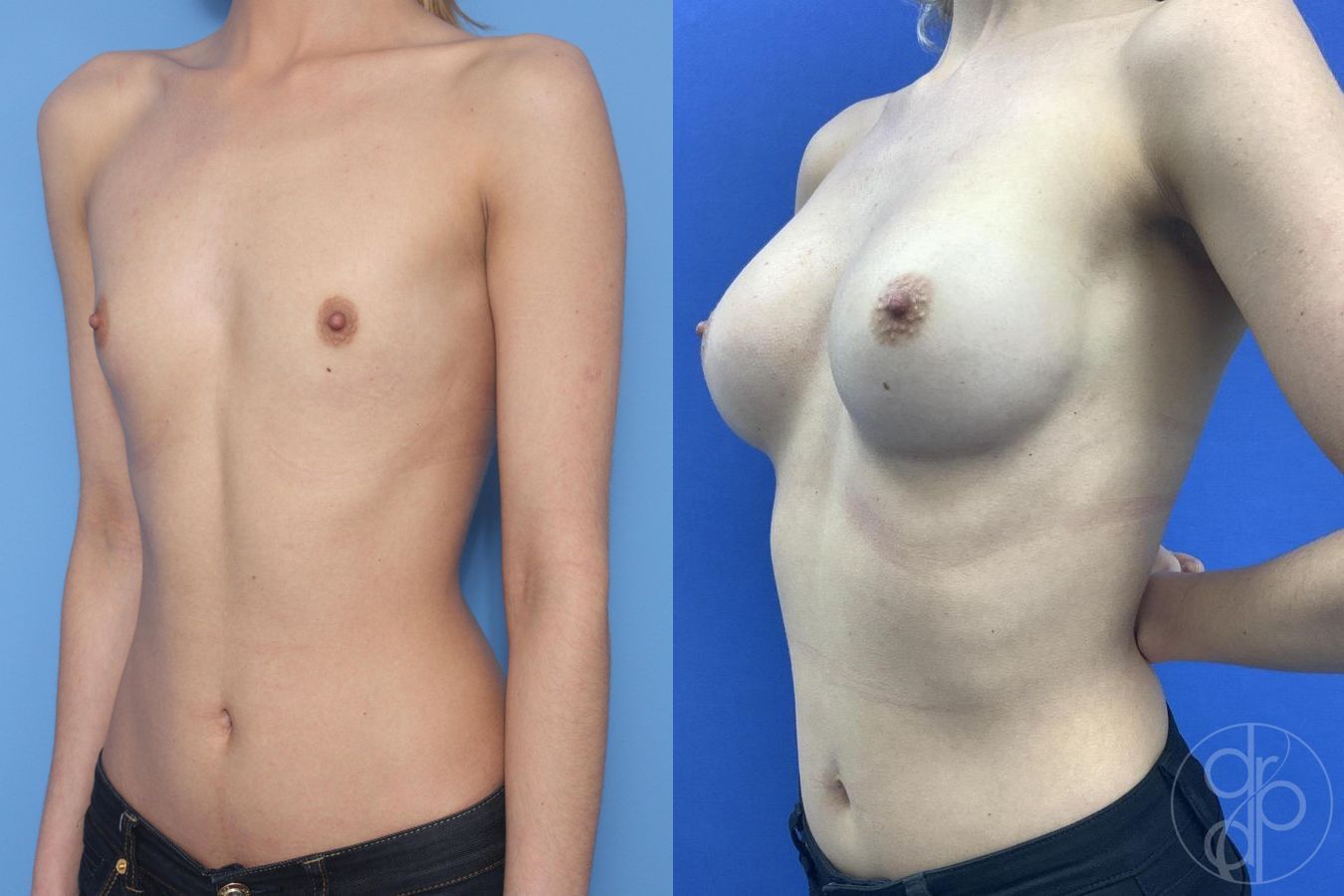 Before and after Breast Augmentation case 29935 - Angle 3