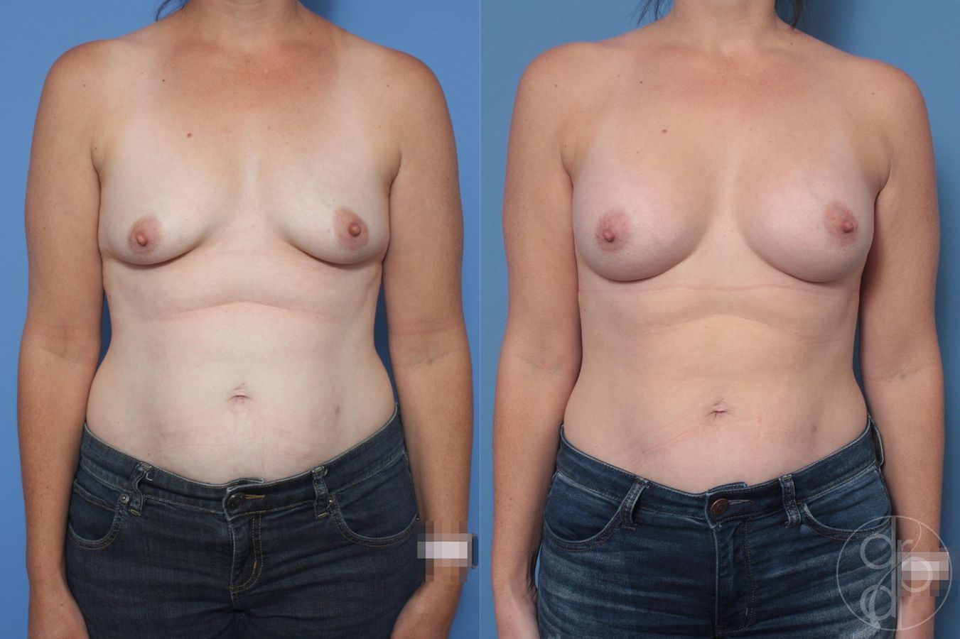 Before and after Breast Augmentation case 29998