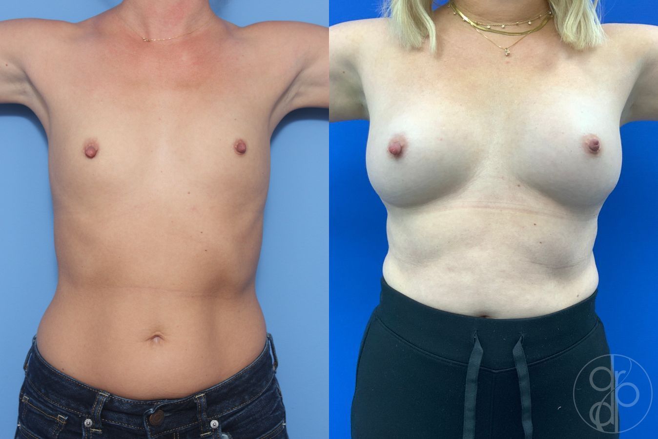 Before and after Breast Augmentation case 46257 - Angle 2