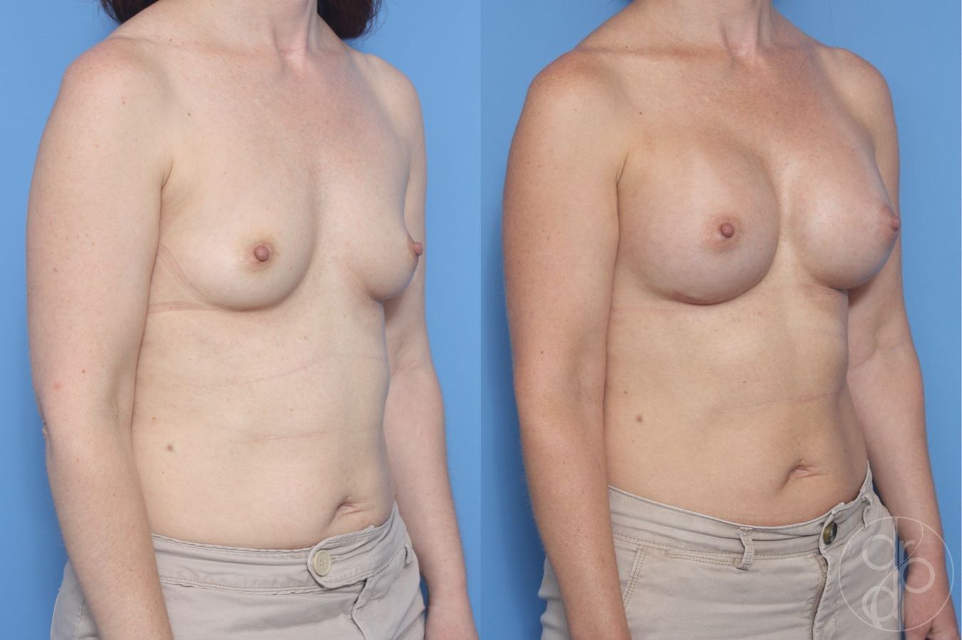 Before and after Breast Augmentation case 29945 - Angle 2