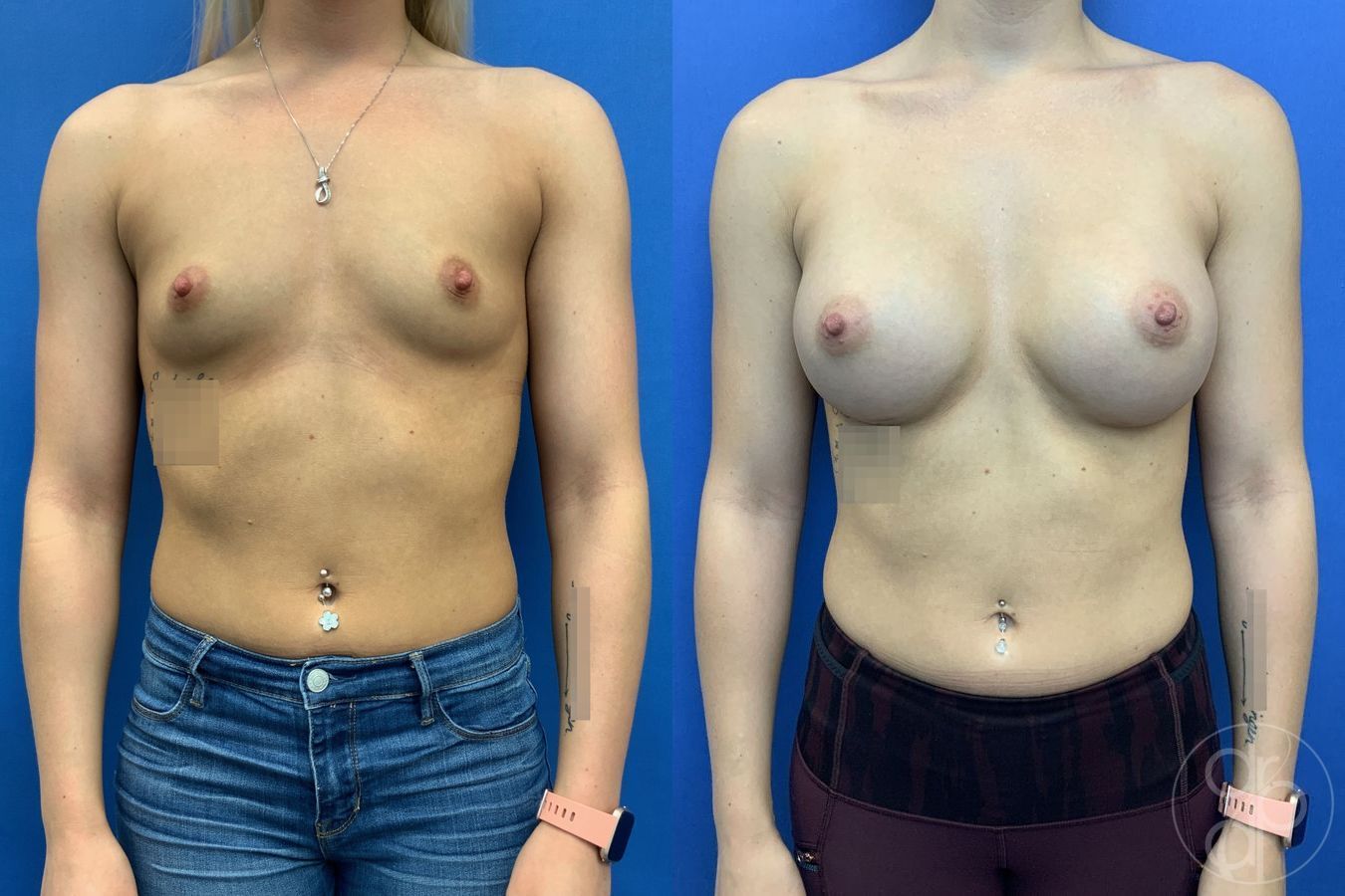 Breast Augmentation - Case 417