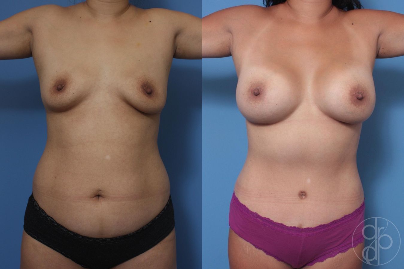 Before and after Breast Augmentation case 29715 - Angle 2