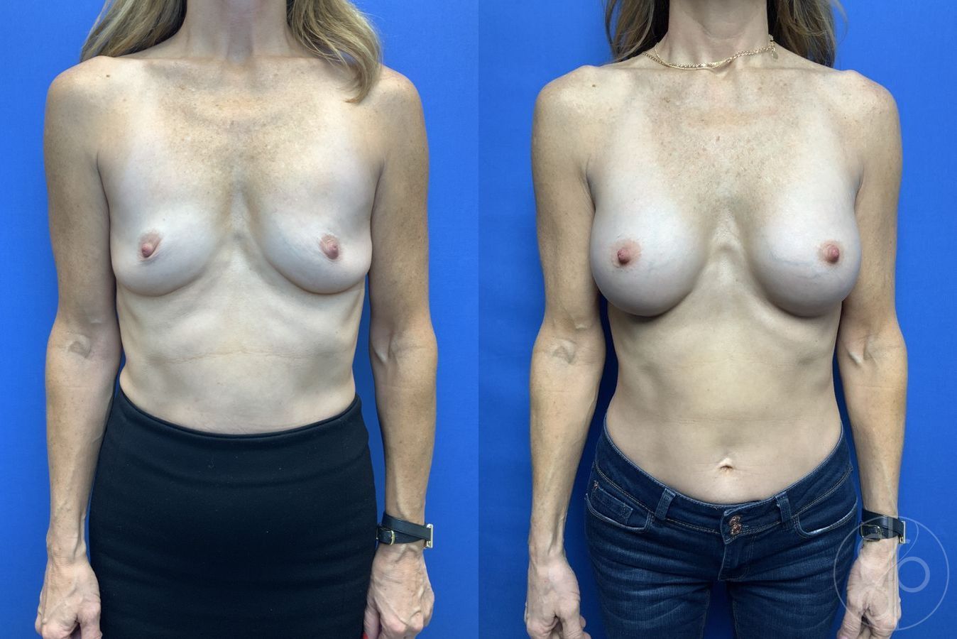 Before and after Breast Augmentation case 29923