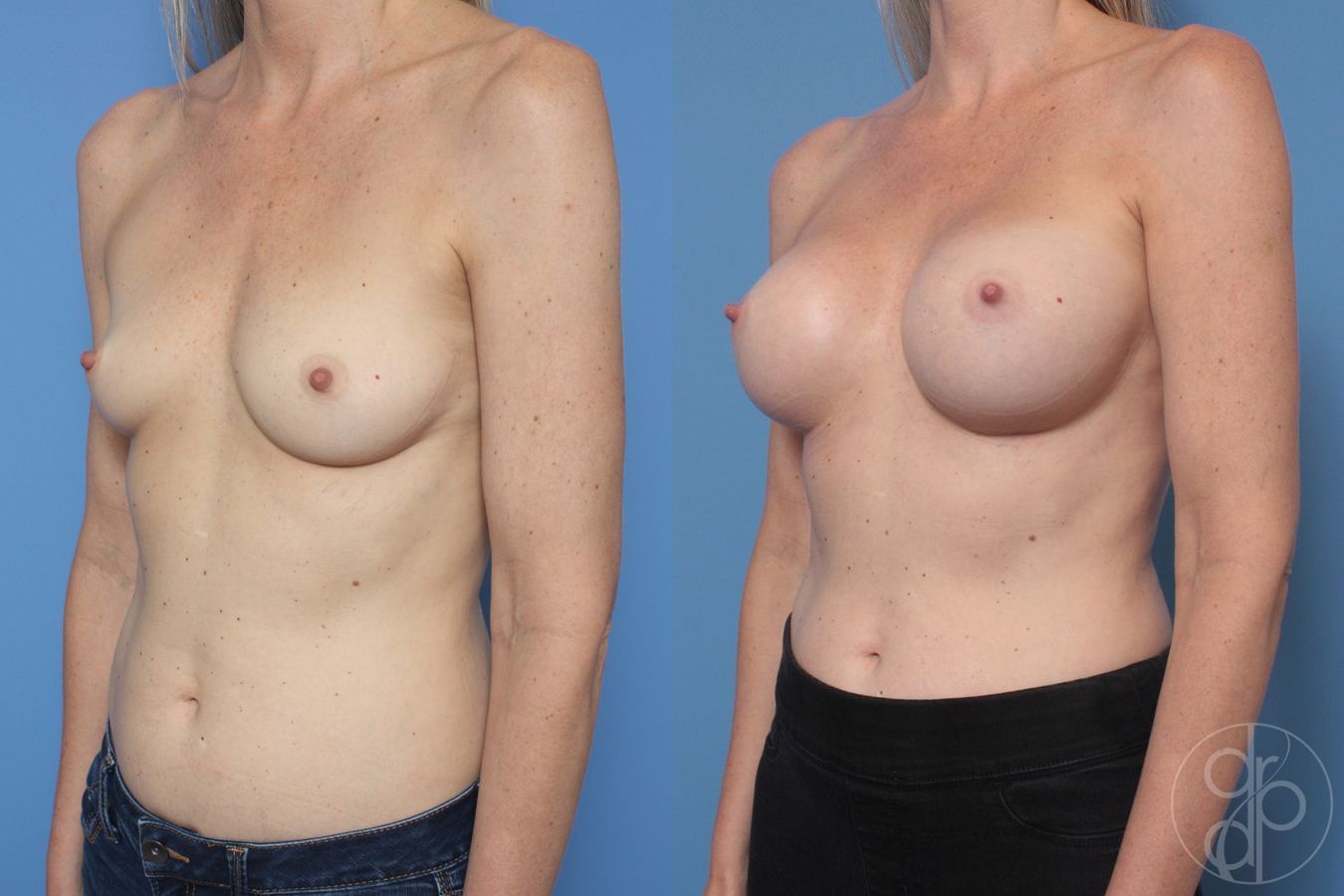 Breast Augmentation - Thumbnail 3