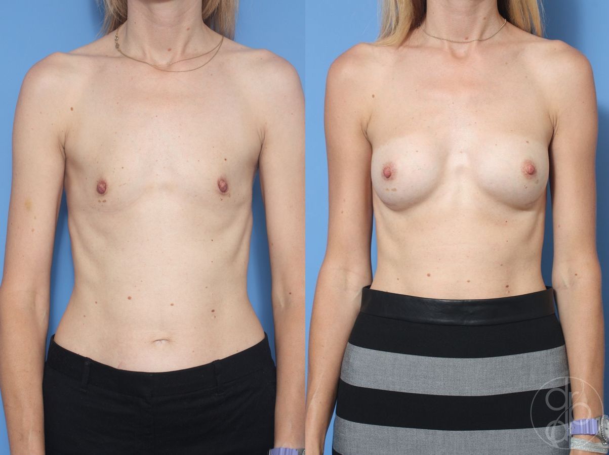 Breast Augmentation - Case 436