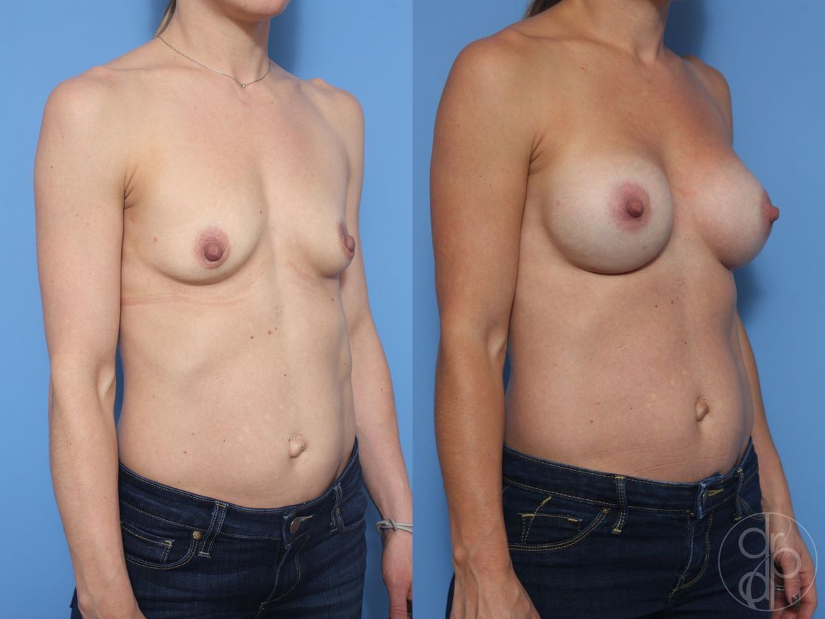 Before and after Breast Augmentation case 29822 - Angle 4
