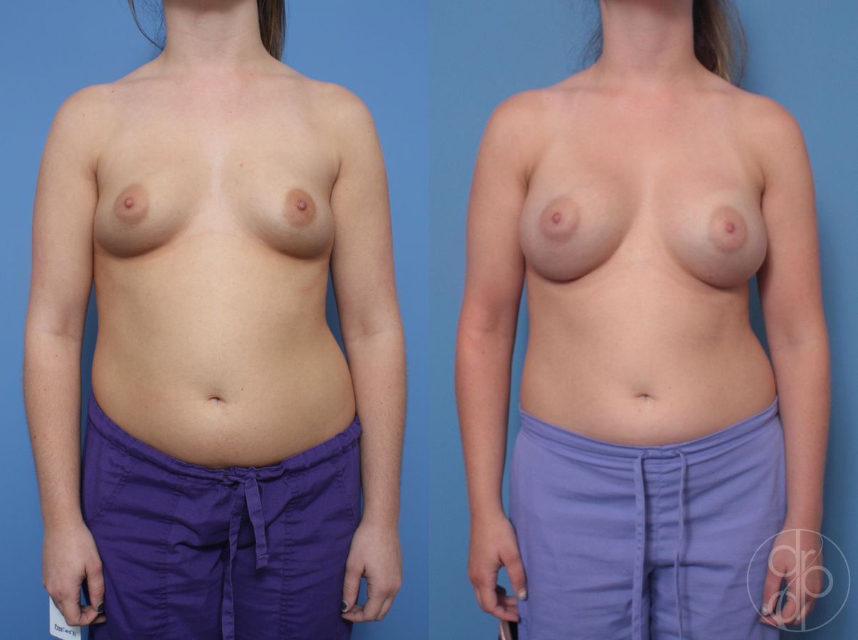 Before and after Breast Augmentation case 29821