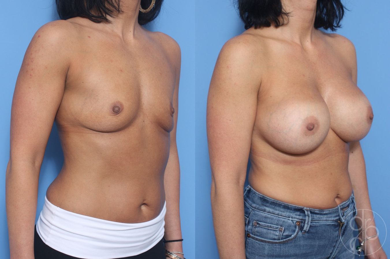 Before and after Breast Augmentation case 29600 - Angle 3