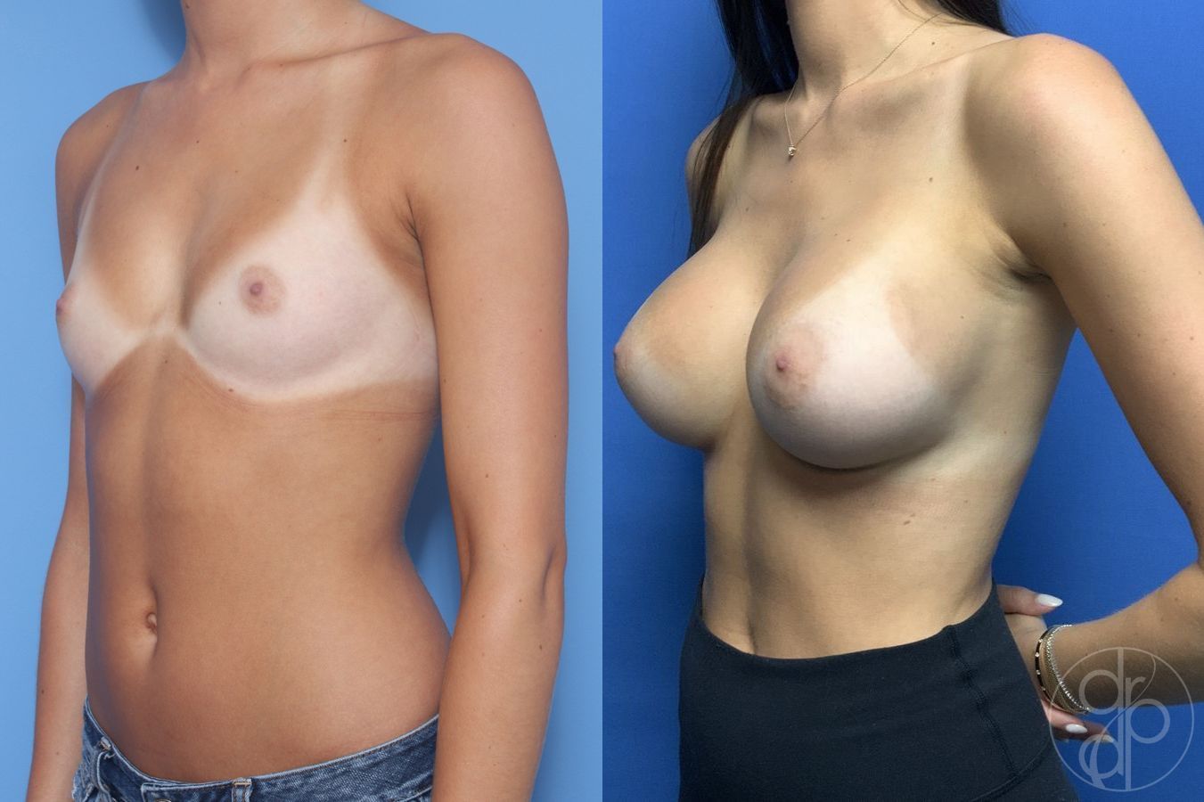 Before and after Breast Augmentation case 29974 - Angle 2