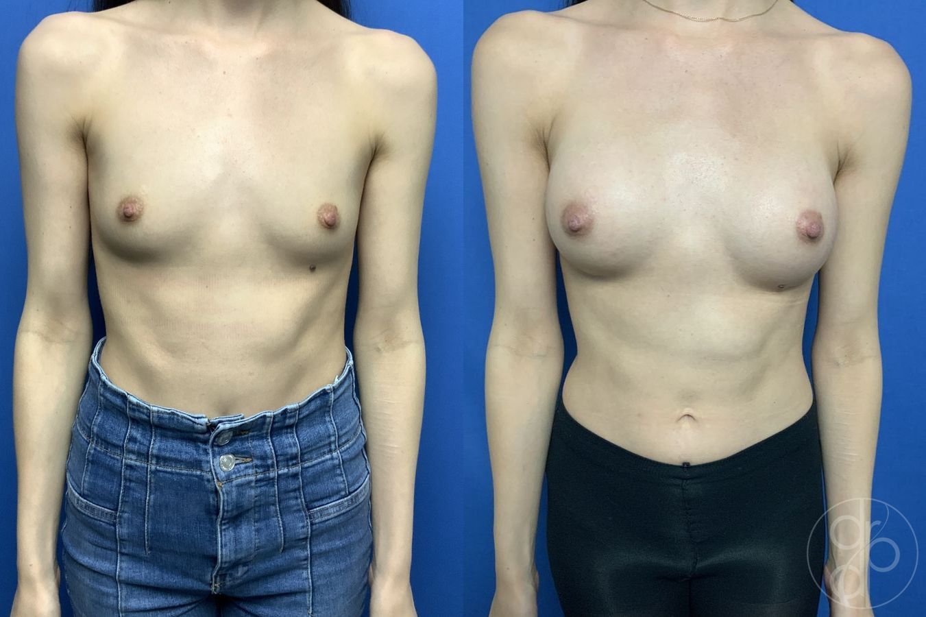 Before and after Breast Augmentation case 29836