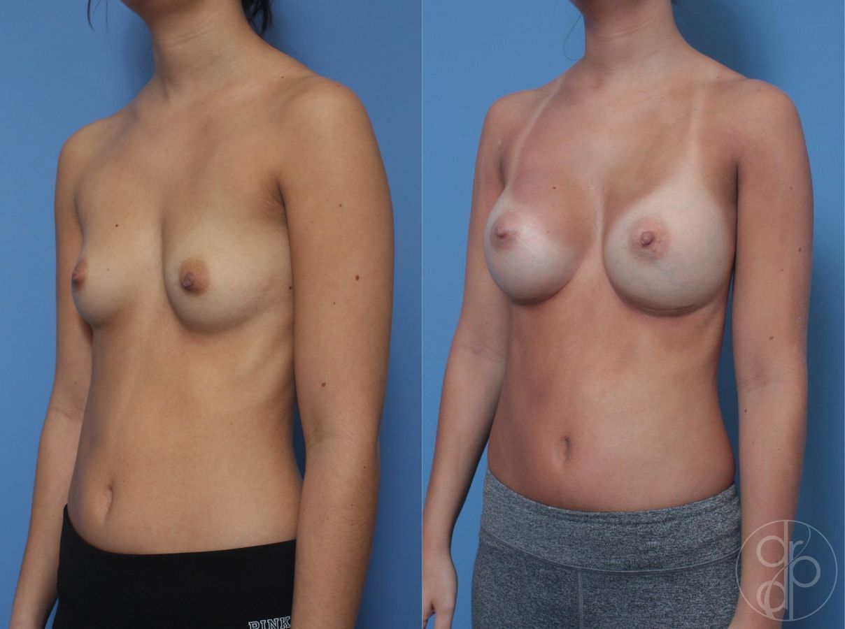 Before and after Breast Augmentation case 29815 - Angle 4