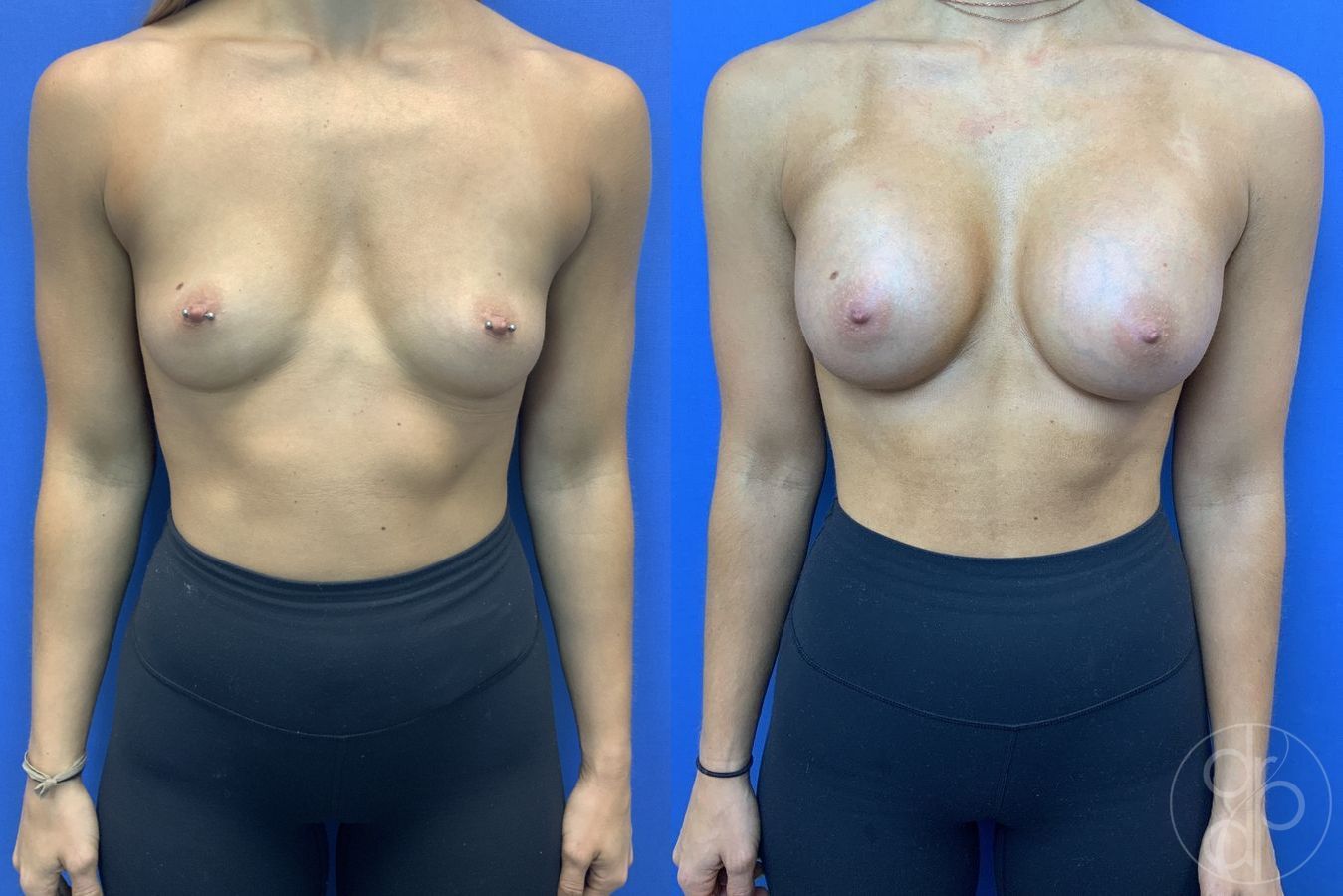 Before and after Breast Augmentation case 29941