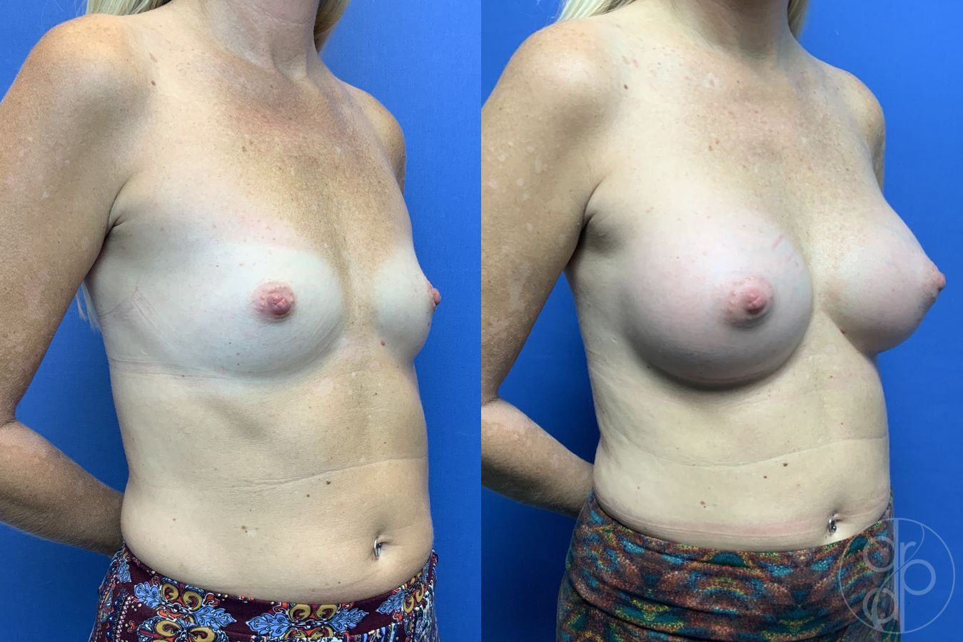 Before and after Breast Augmentation case 29960 - Angle 2