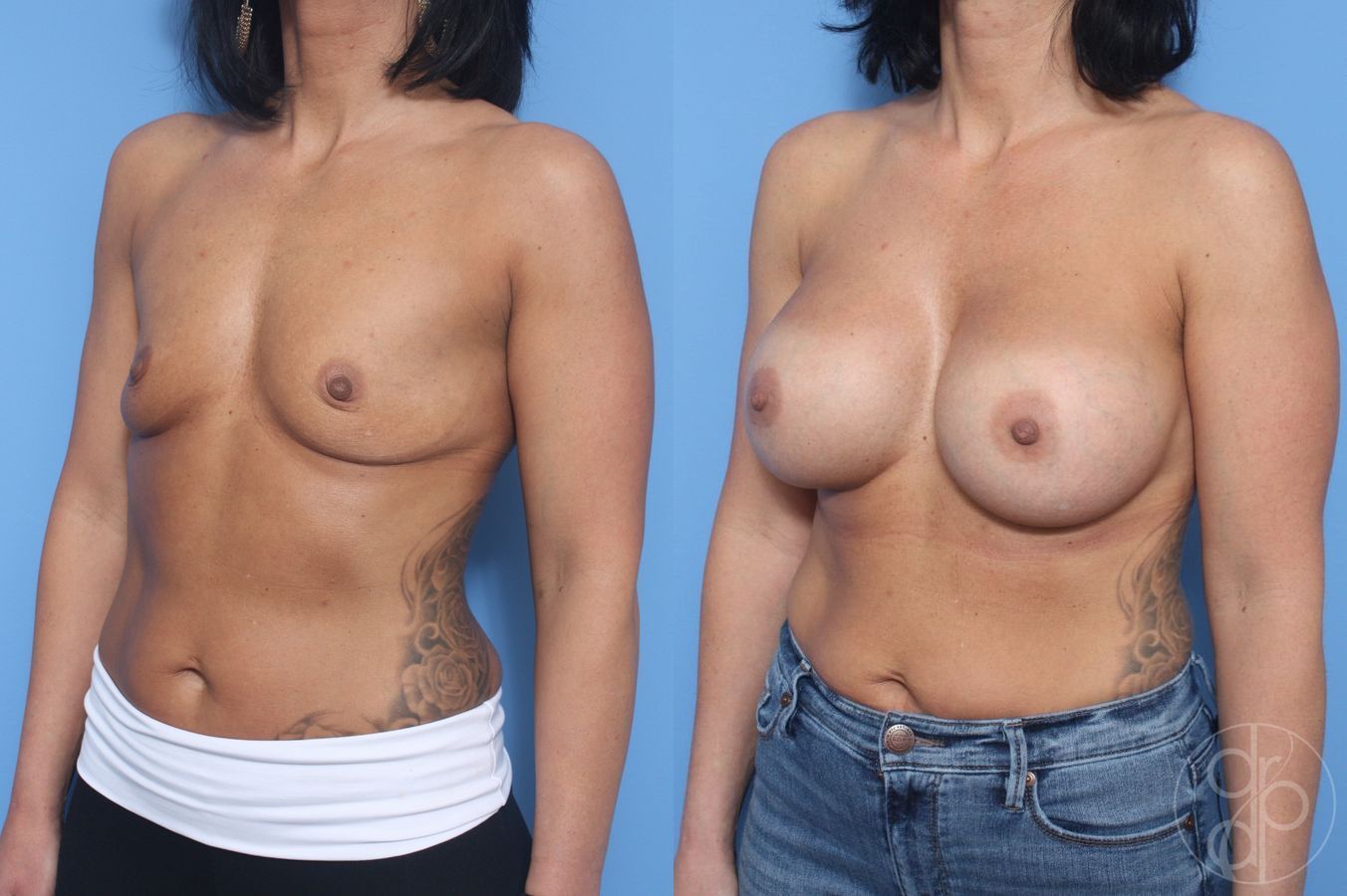 Before and after Breast Augmentation case 29600 - Angle 2