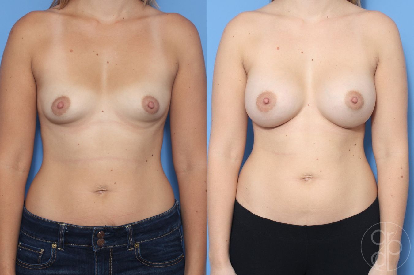 Before and after Breast Augmentation case 29875