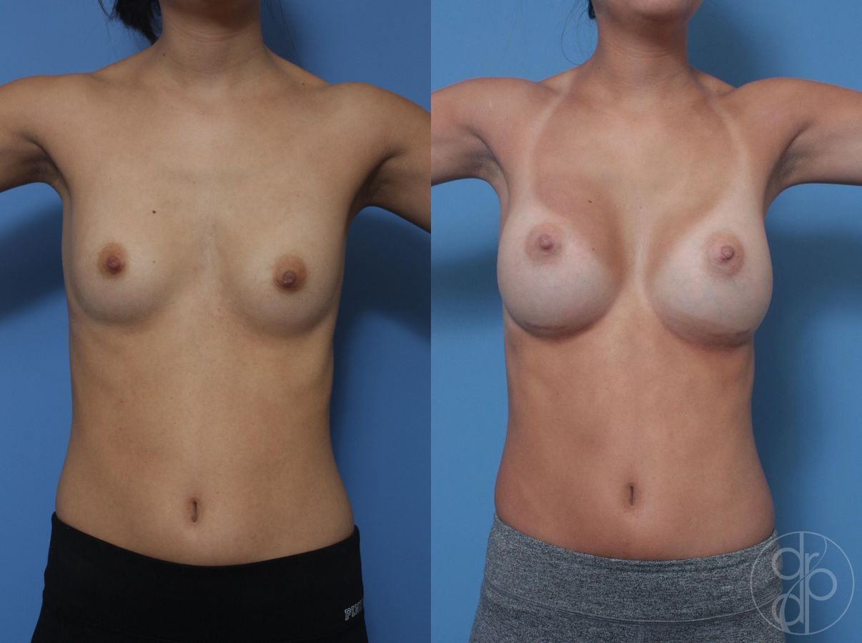 Before and after Breast Augmentation case 29815 - Angle 2