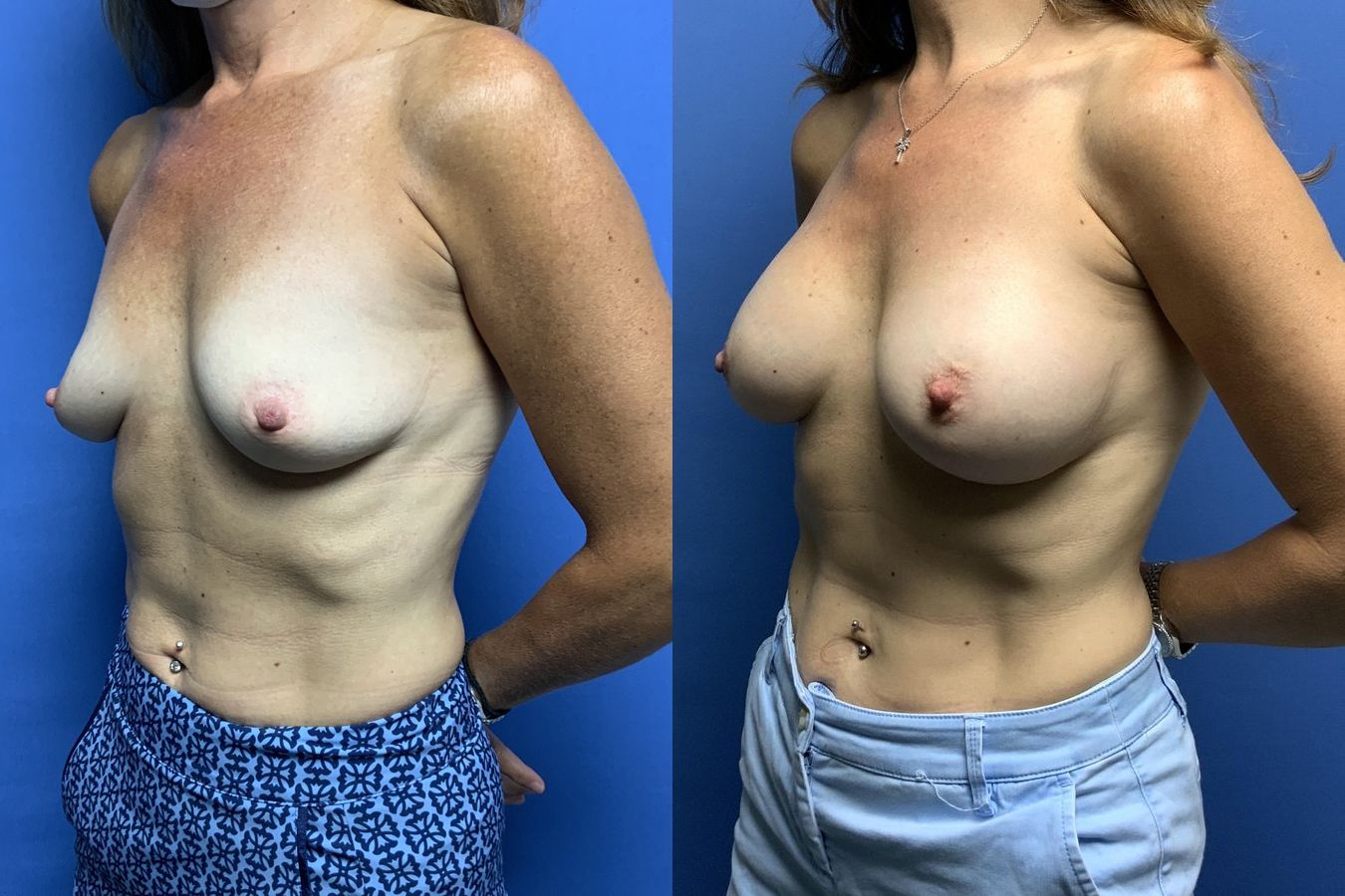 Breast Augmentation - Thumbnail 3