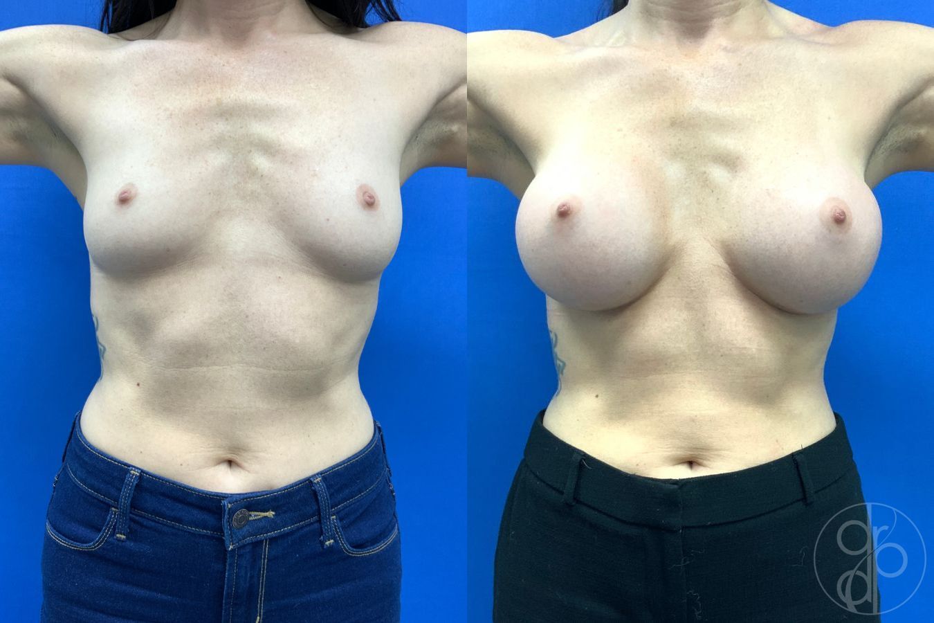 Before and after Breast Augmentation case 43194 - Angle 2
