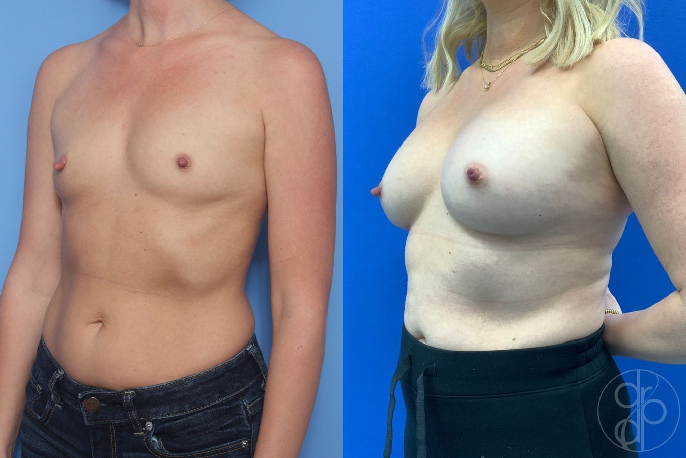 Before and after Breast Augmentation case 46257 - Angle 3