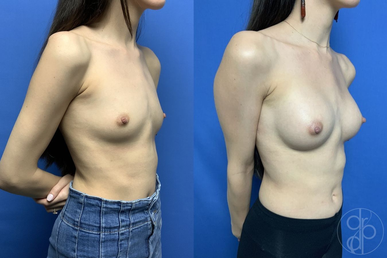 Before and after Breast Augmentation case 29836 - Angle 2