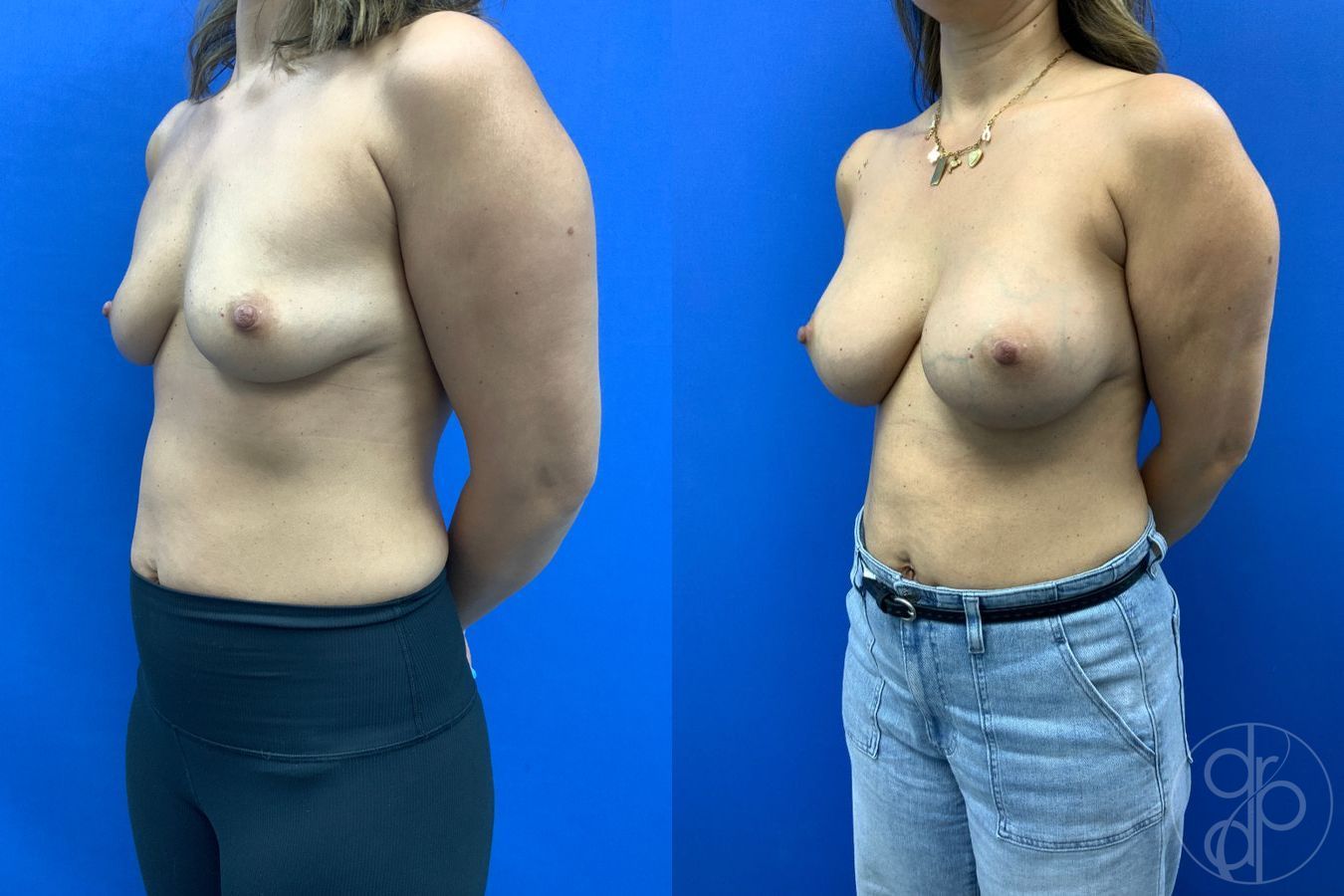 Before and after Breast Augmentation case 46261 - Angle 4