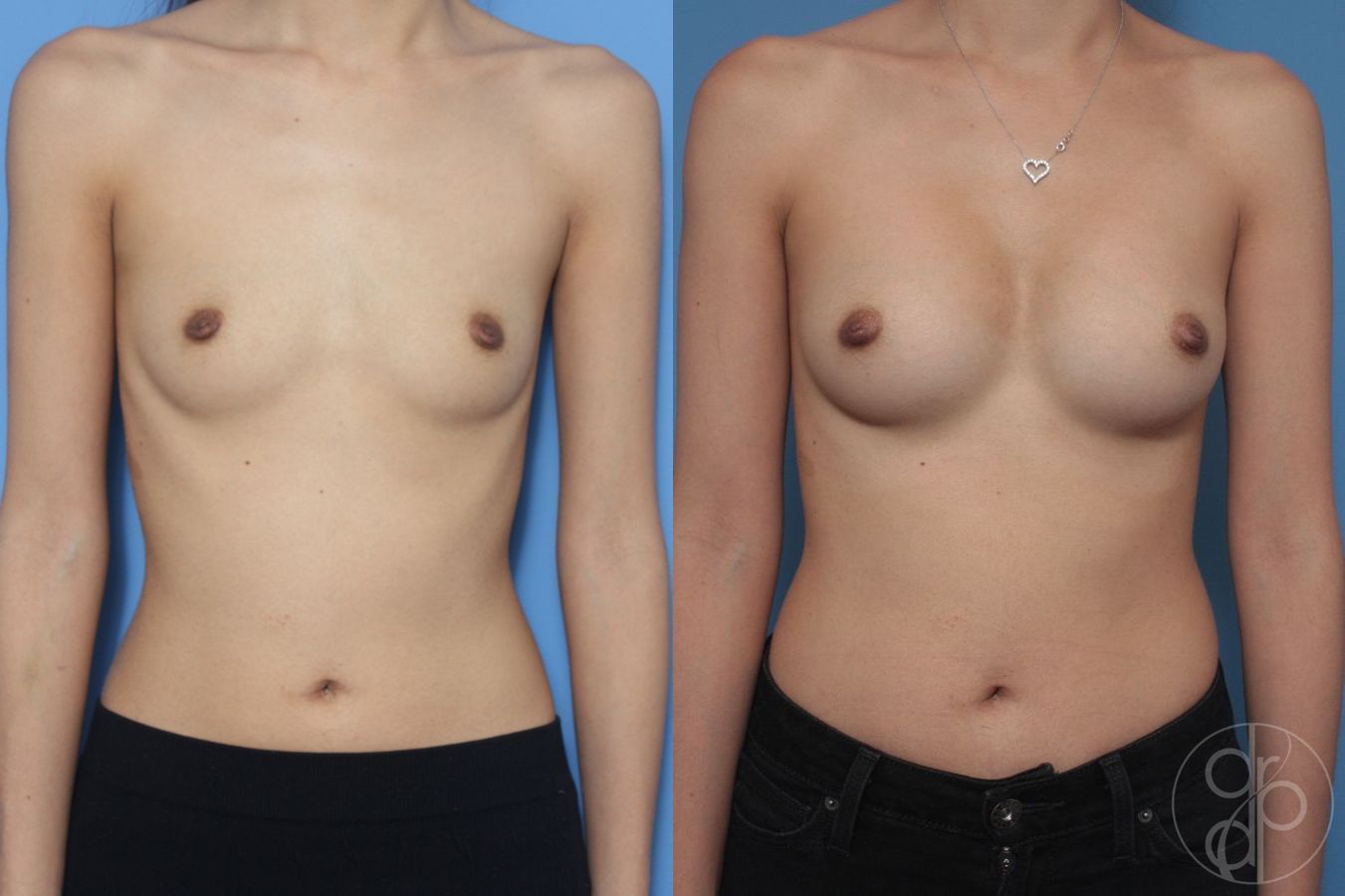 Before and after Breast Augmentation case 29833