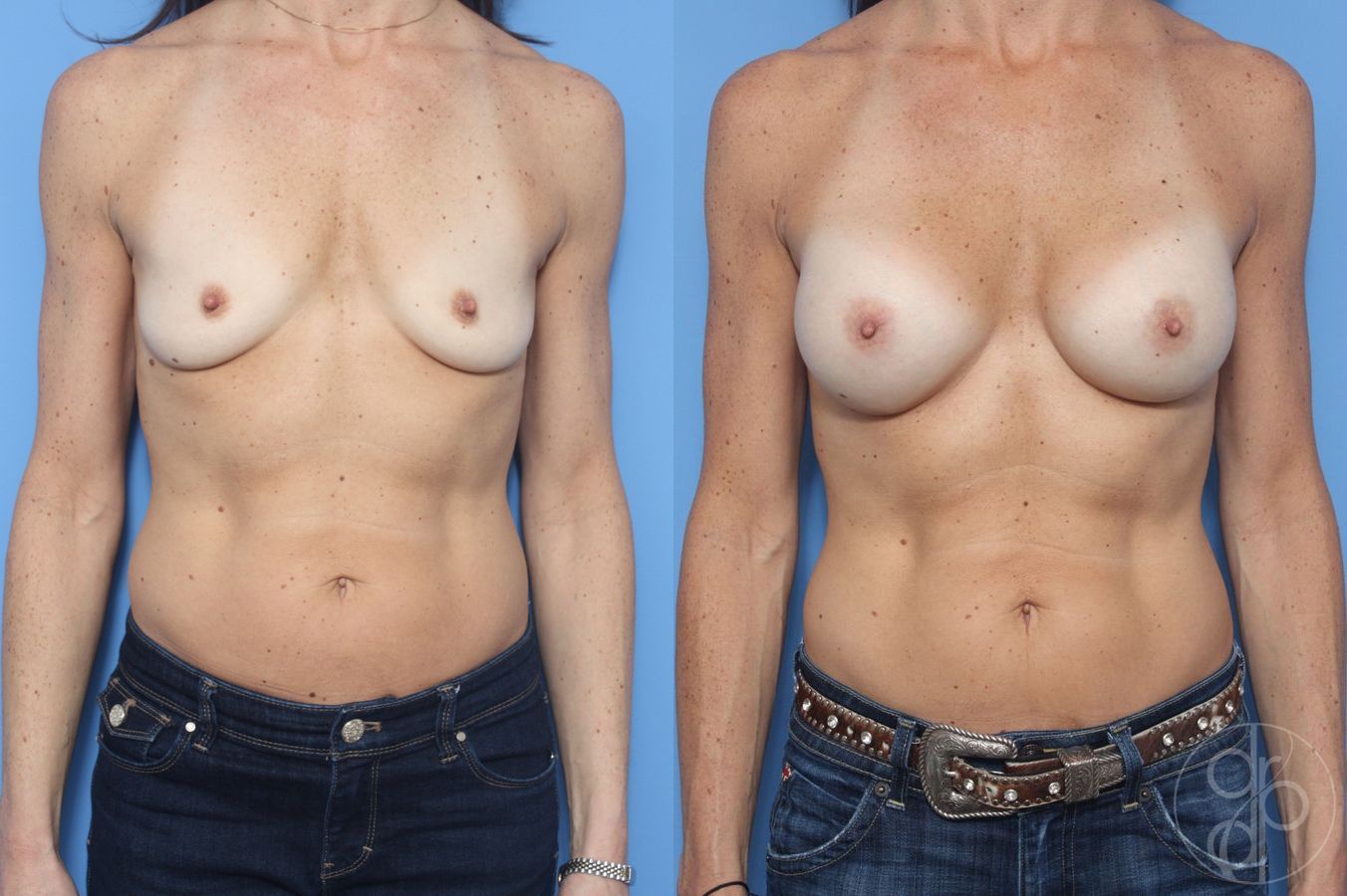 Before and after Breast Augmentation case 29911
