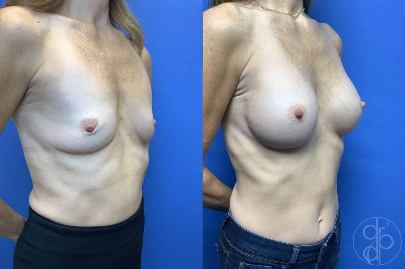 Before and after Breast Augmentation case 29923 - Angle 2