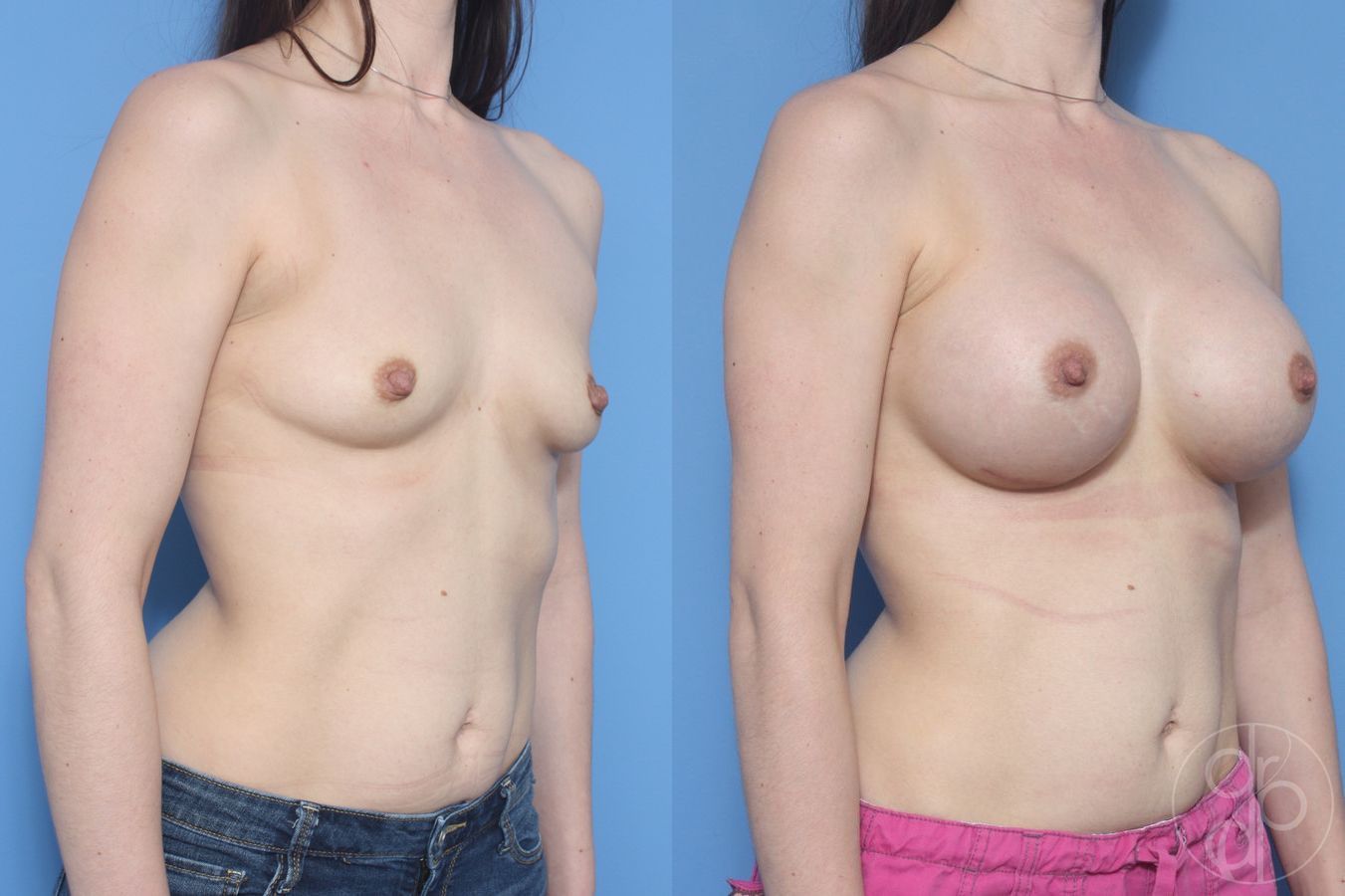Before and after Breast Augmentation case 29609 - Angle 3