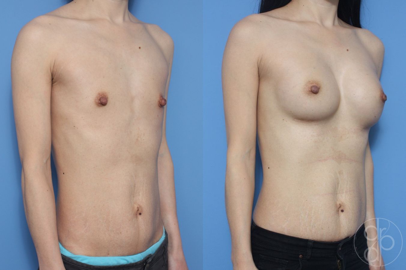Before and after Breast Augmentation case 29907 - Angle 2