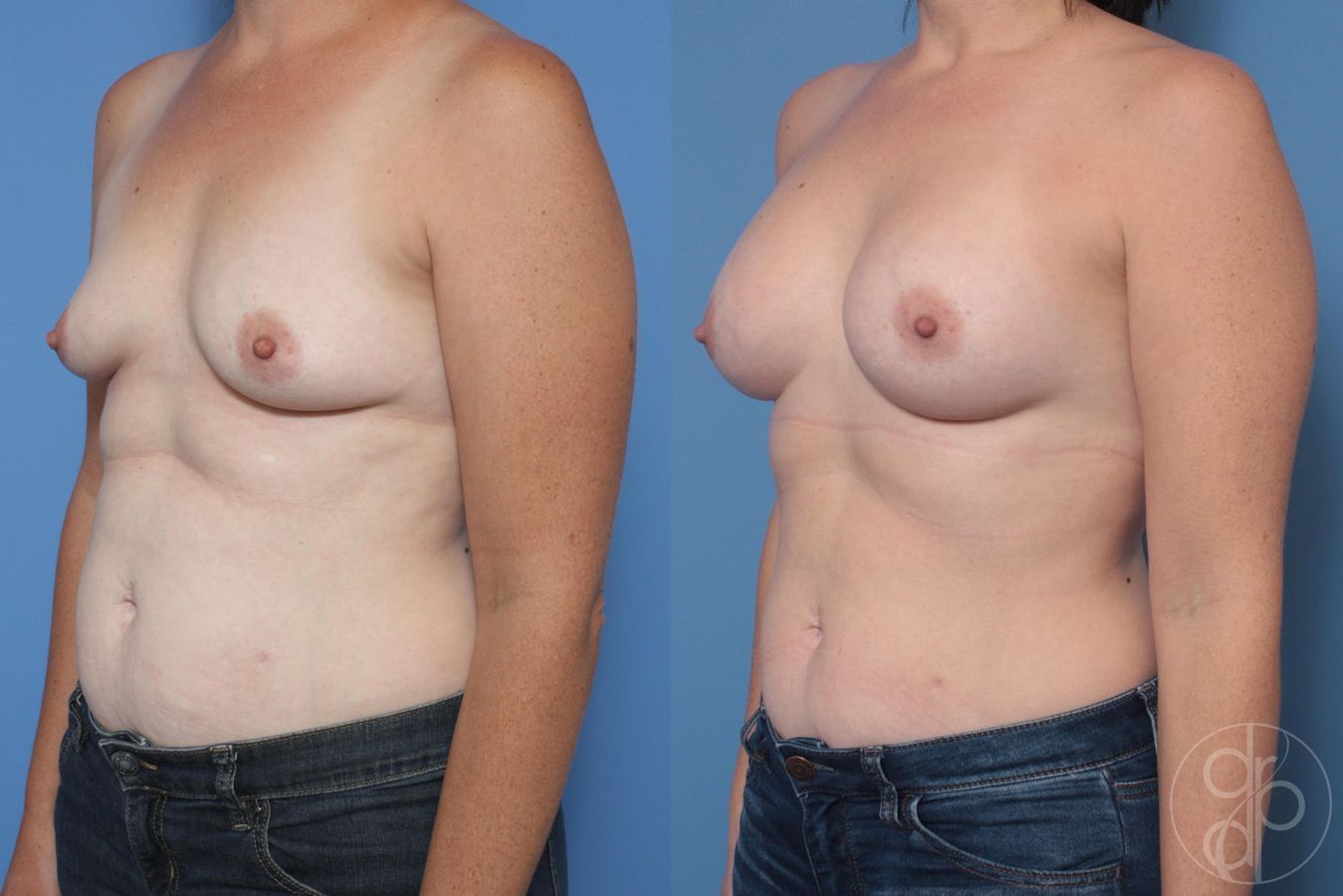 Before and after Breast Augmentation case 29998 - Angle 4