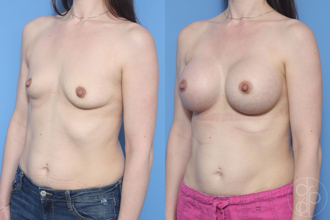 Before and after Breast Augmentation case 29609 - Angle 2