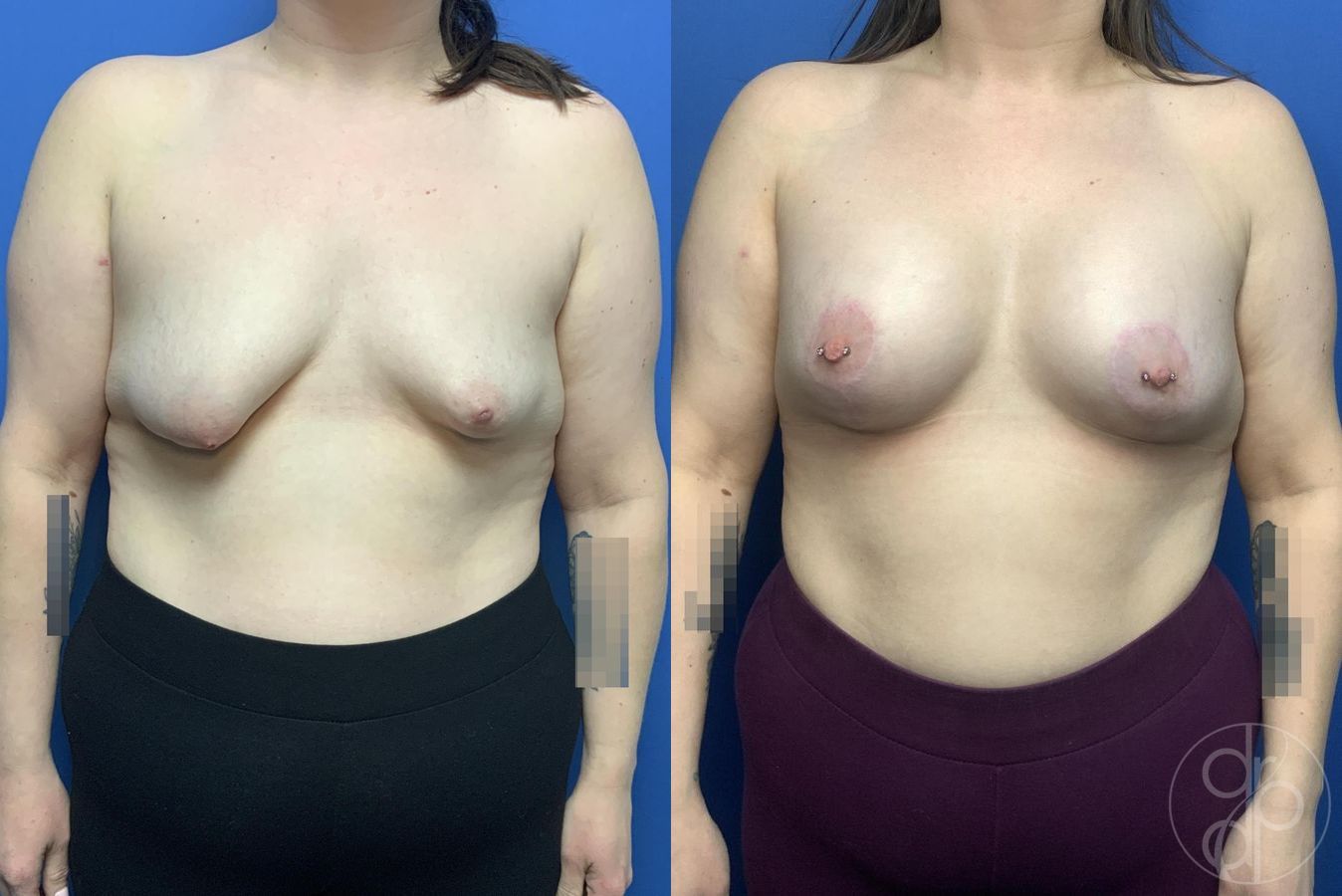 Before and after Breast Augmentation case 29979