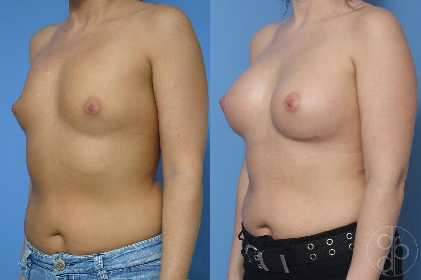 Before and after Breast Augmentation case 29915 - Angle 3