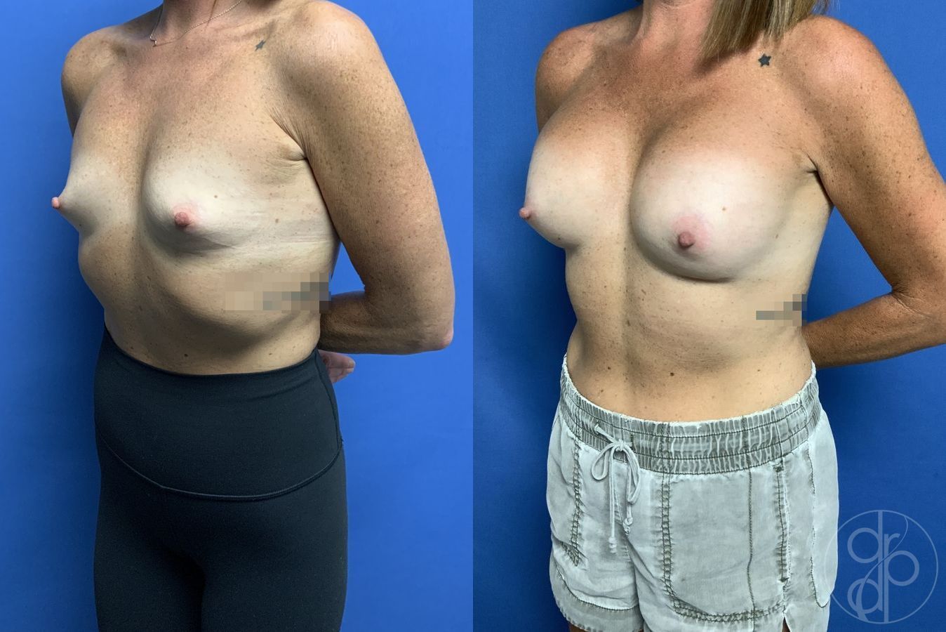 Before and after Breast Augmentation case 29838 - Angle 3