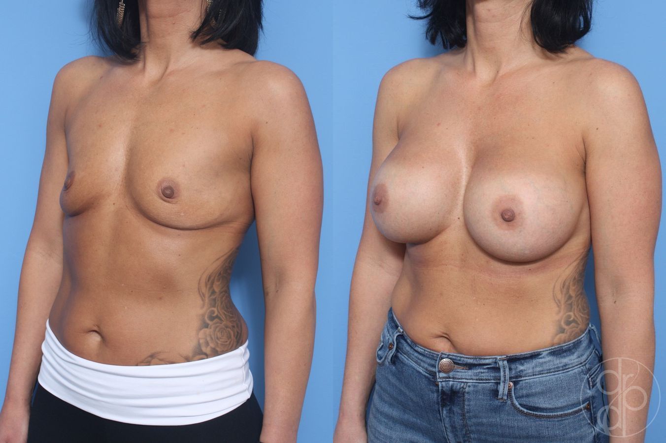 Breast Augmentation - Thumbnail 2