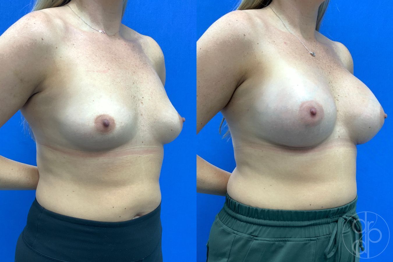 Before and after Breast Augmentation case 43197 - Angle 3