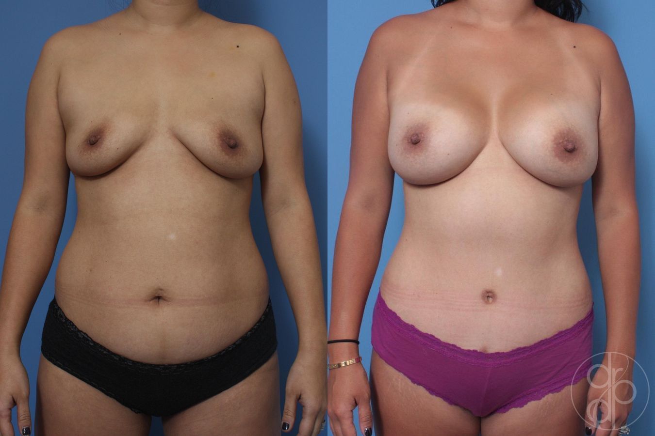 Before and after Breast Augmentation case 29715