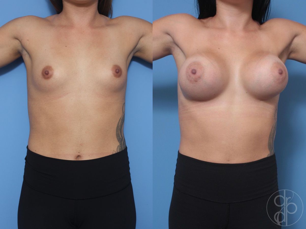 Before and after Breast Augmentation case 29819 - Angle 2