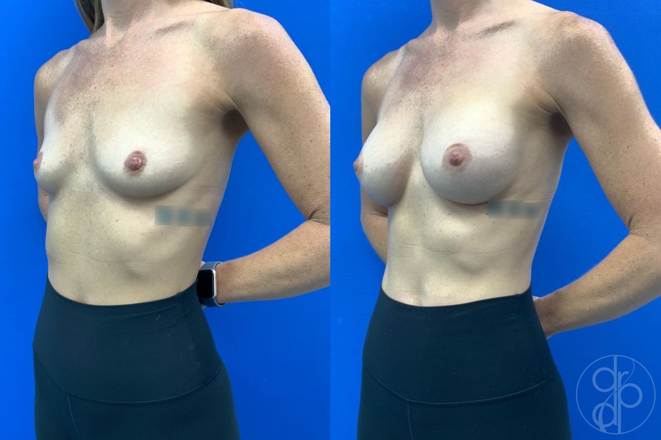 Before and after Breast Augmentation case 46252 - Angle 3